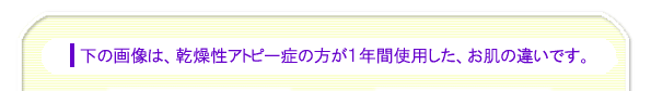 乾燥性アトピー症の方が１年間使用した、お肌の違い